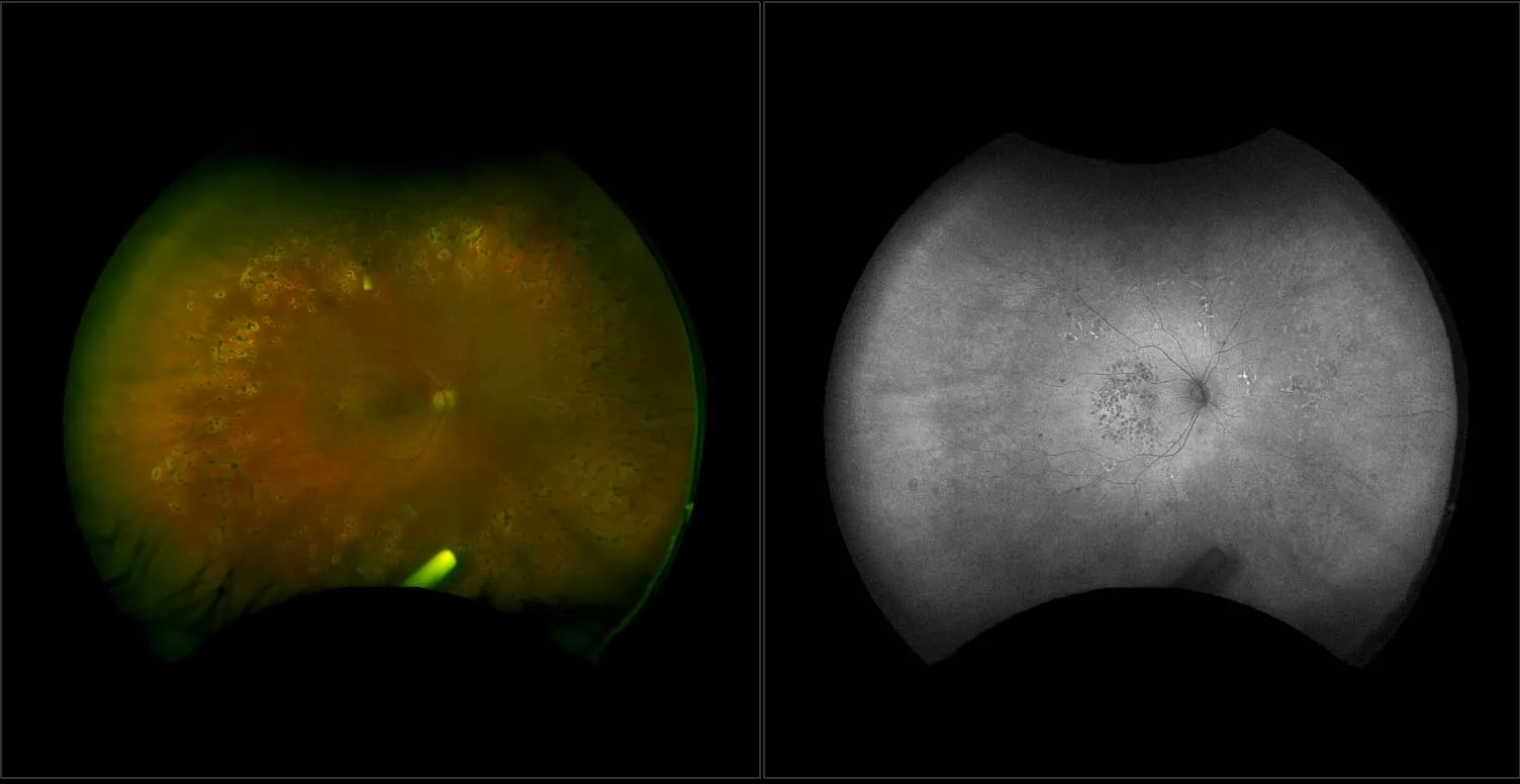 California - Diabetic Macular Edema with Ozurdex Implant, RG, AF