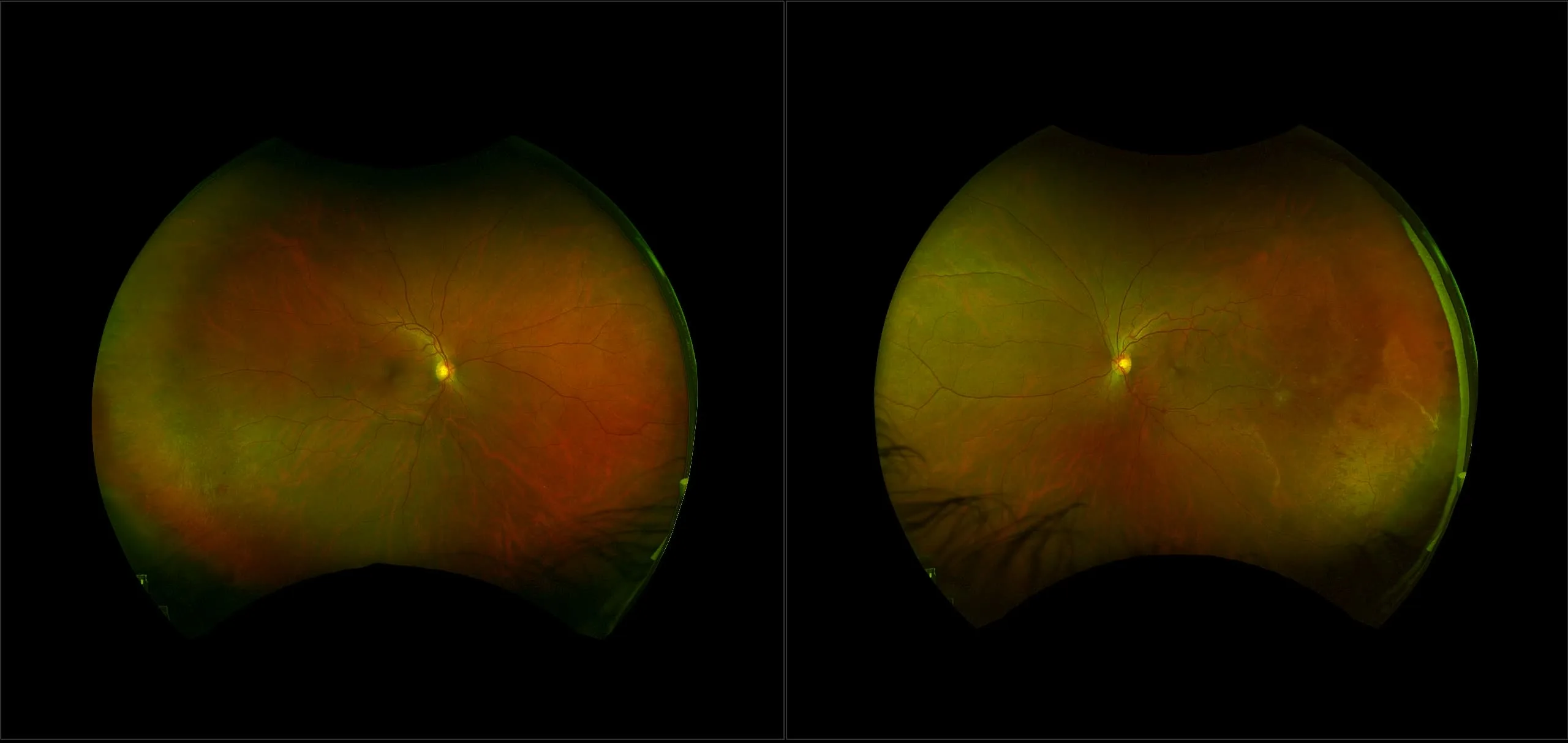 California - Mild Non-Proliferative Diabetic Retinopathy with Macular Edema, RG