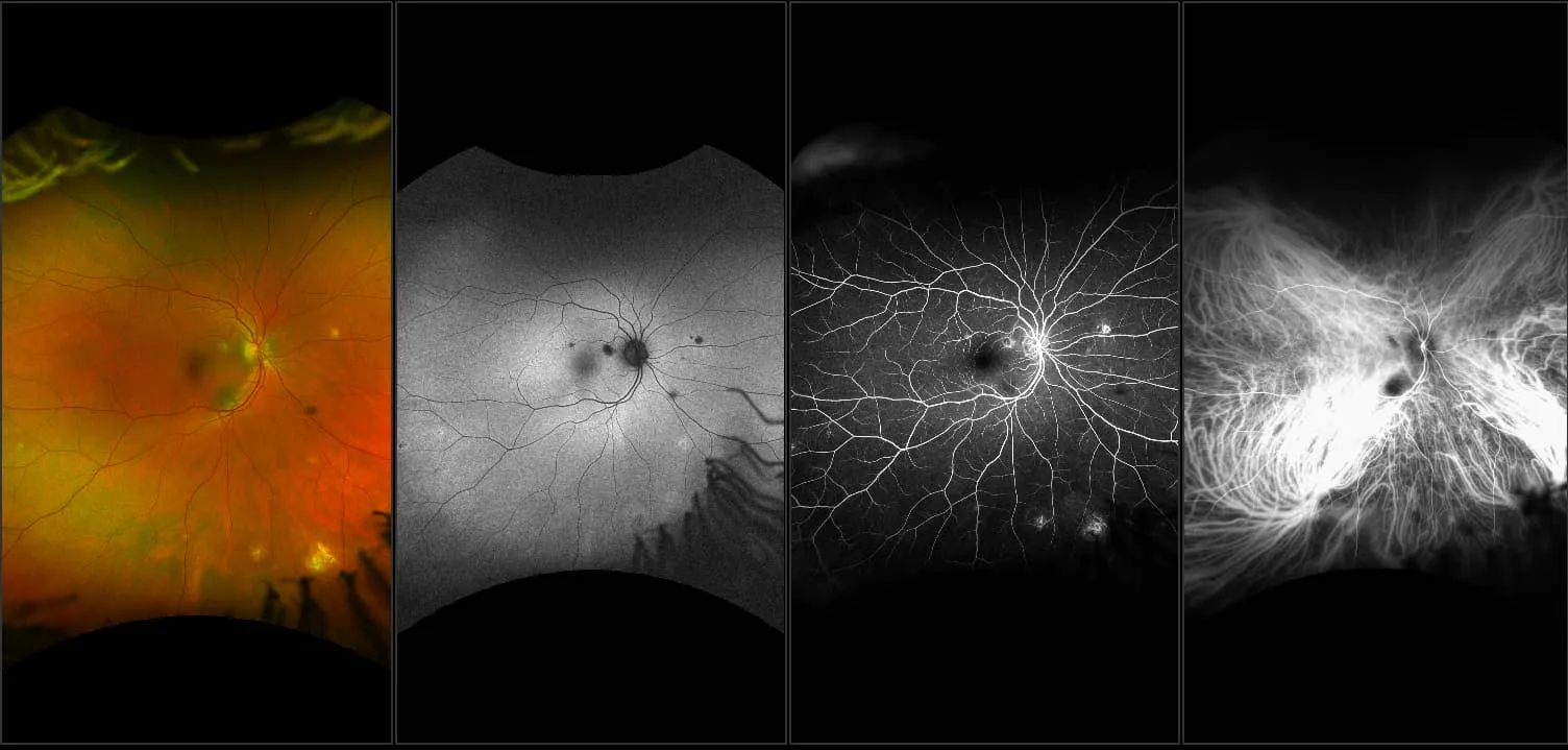 California - Uveitis, RG, AF, FA, ICG