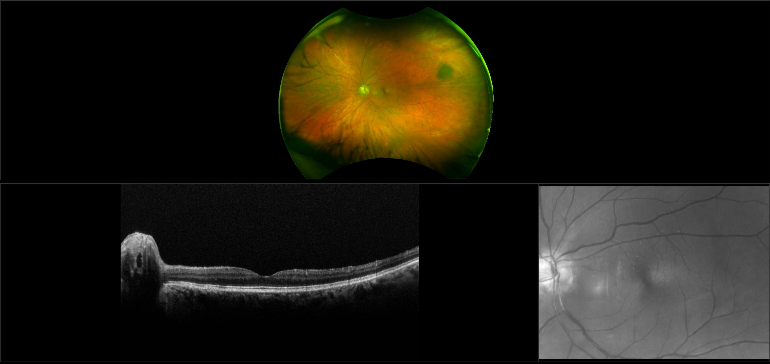 Monaco - Glaucoma, Deep Cup - RG, OCT - Retinal, ONH