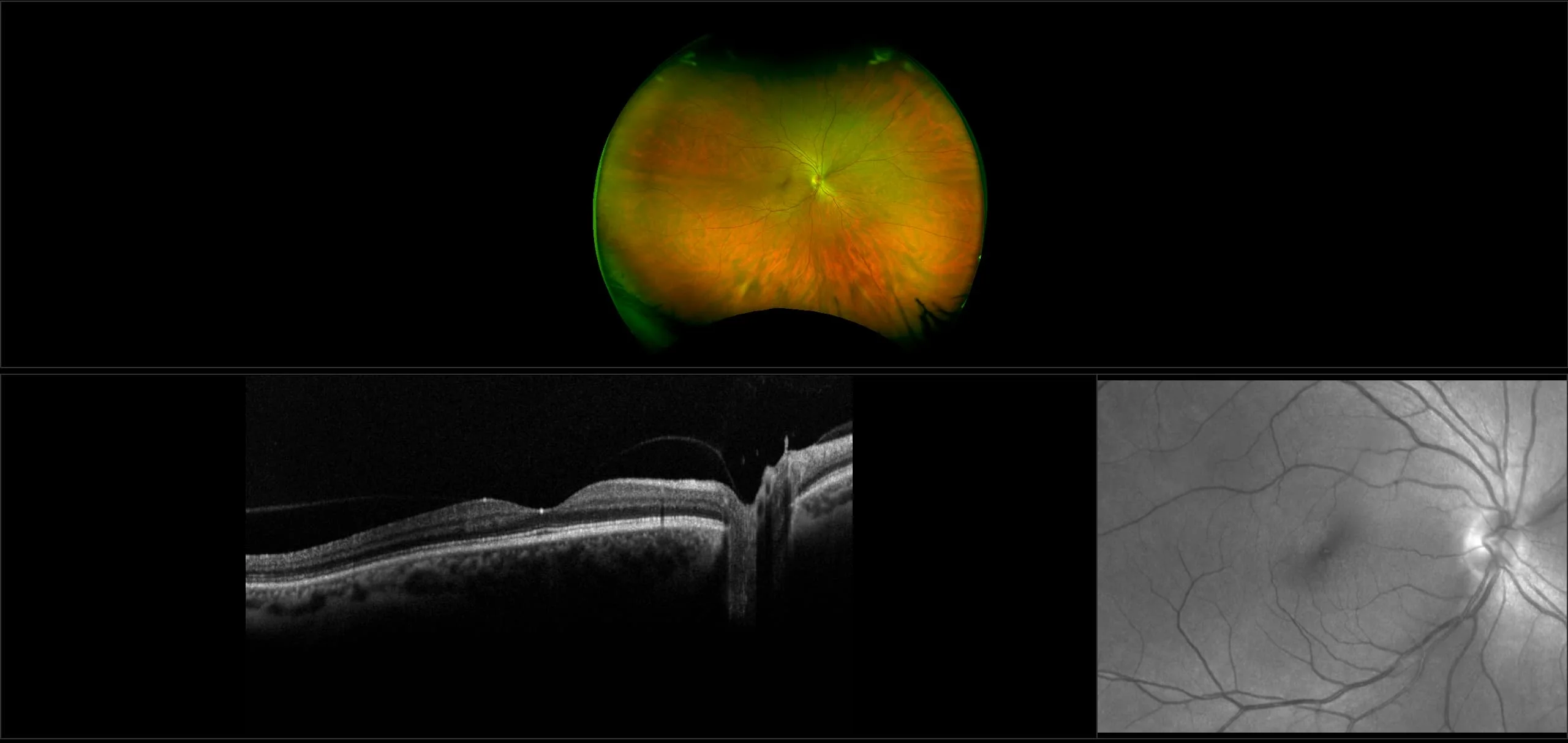 Monaco - Posterior Vitreous Detachment, RG, OCT