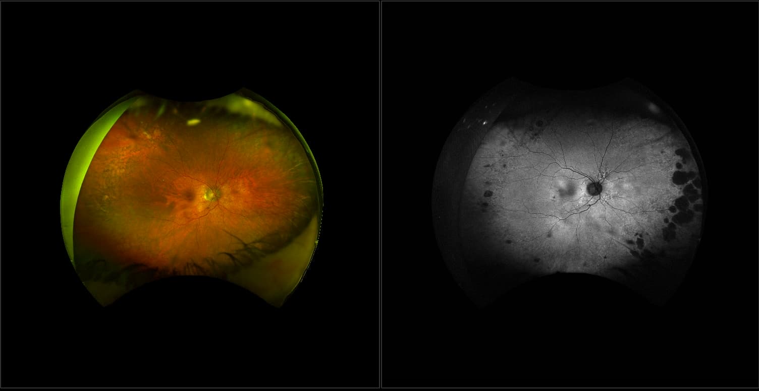 Acute posterior multifocal placoid pigment epitheliopathy (APMPPE)