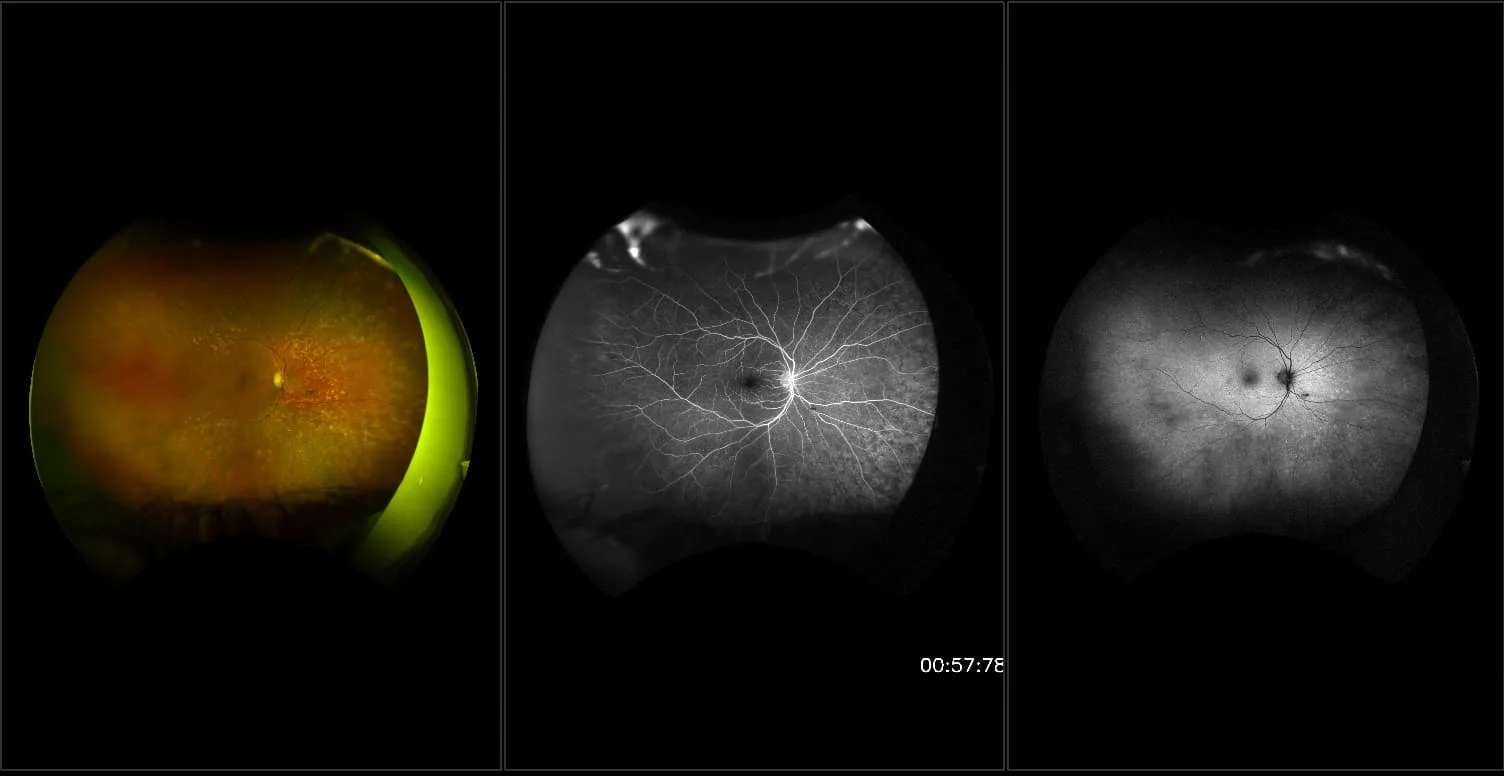 California - Branch Retinal Artery Occlusion, RG, AF, FA