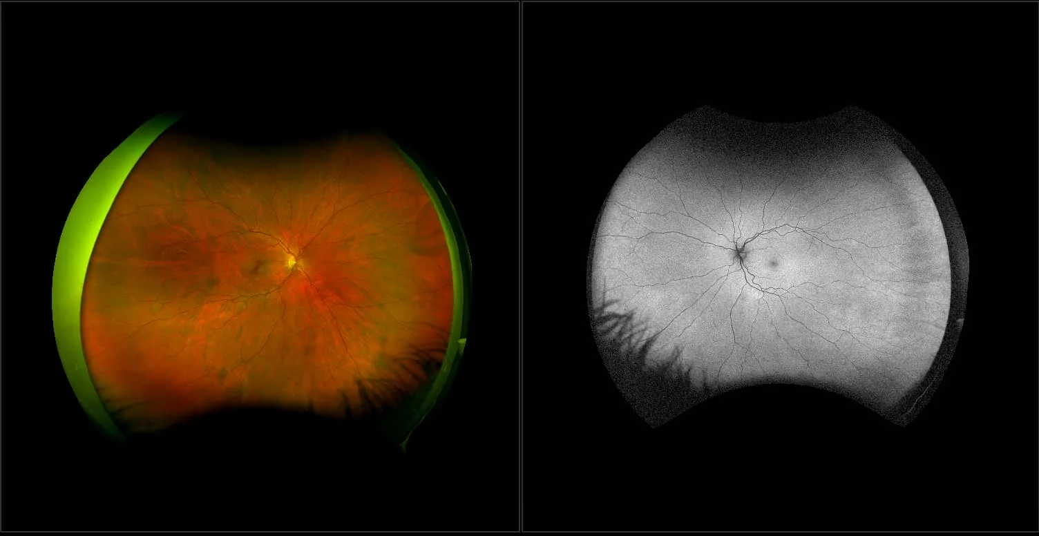 California - Choroidal Nevus, RG, AF