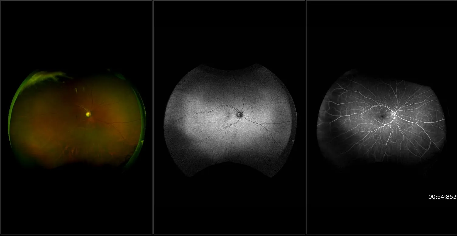 California - Hemi Retinal Vein Occlusion, RG, AF, FA