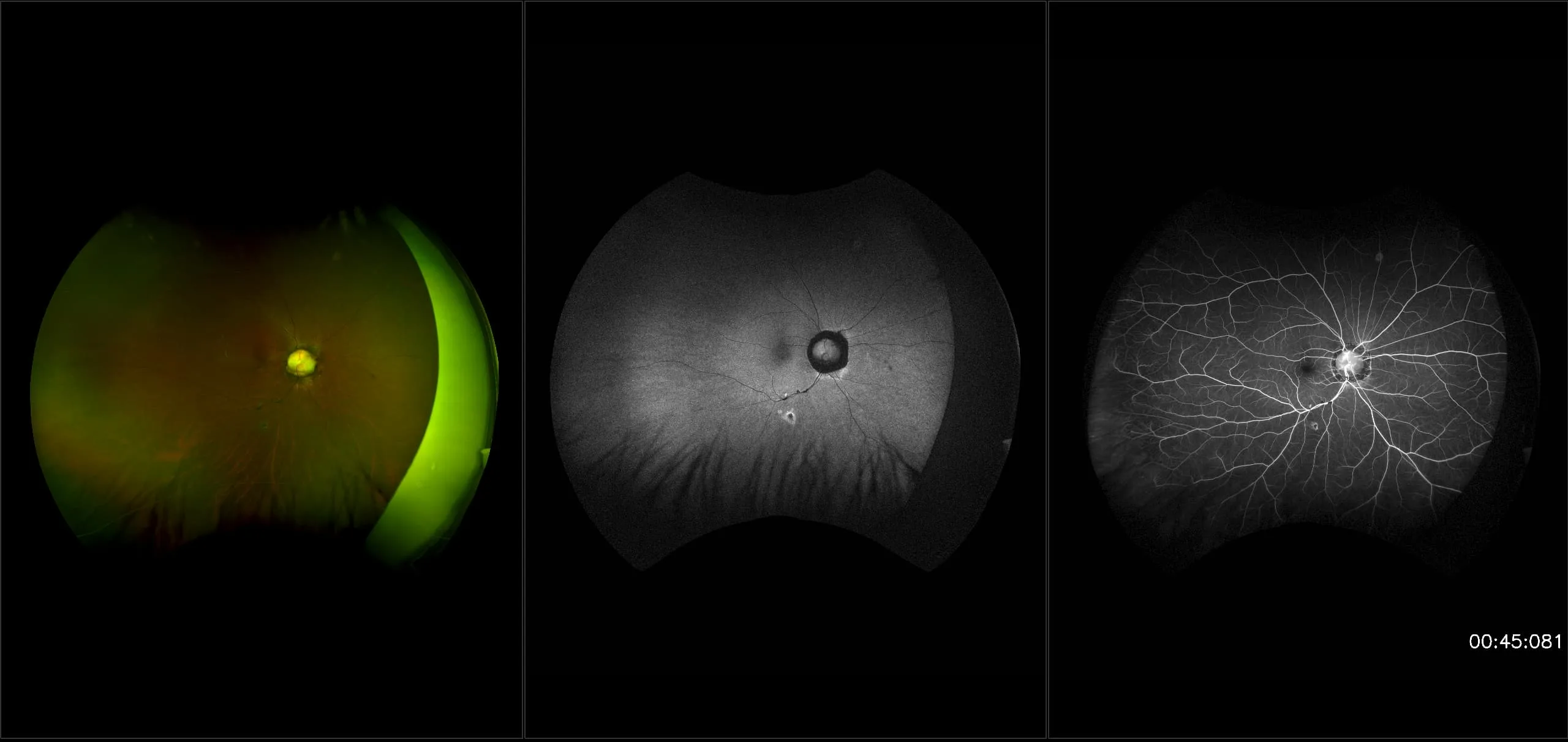 California - Morning Glory Syndrome, RG, AF, FA