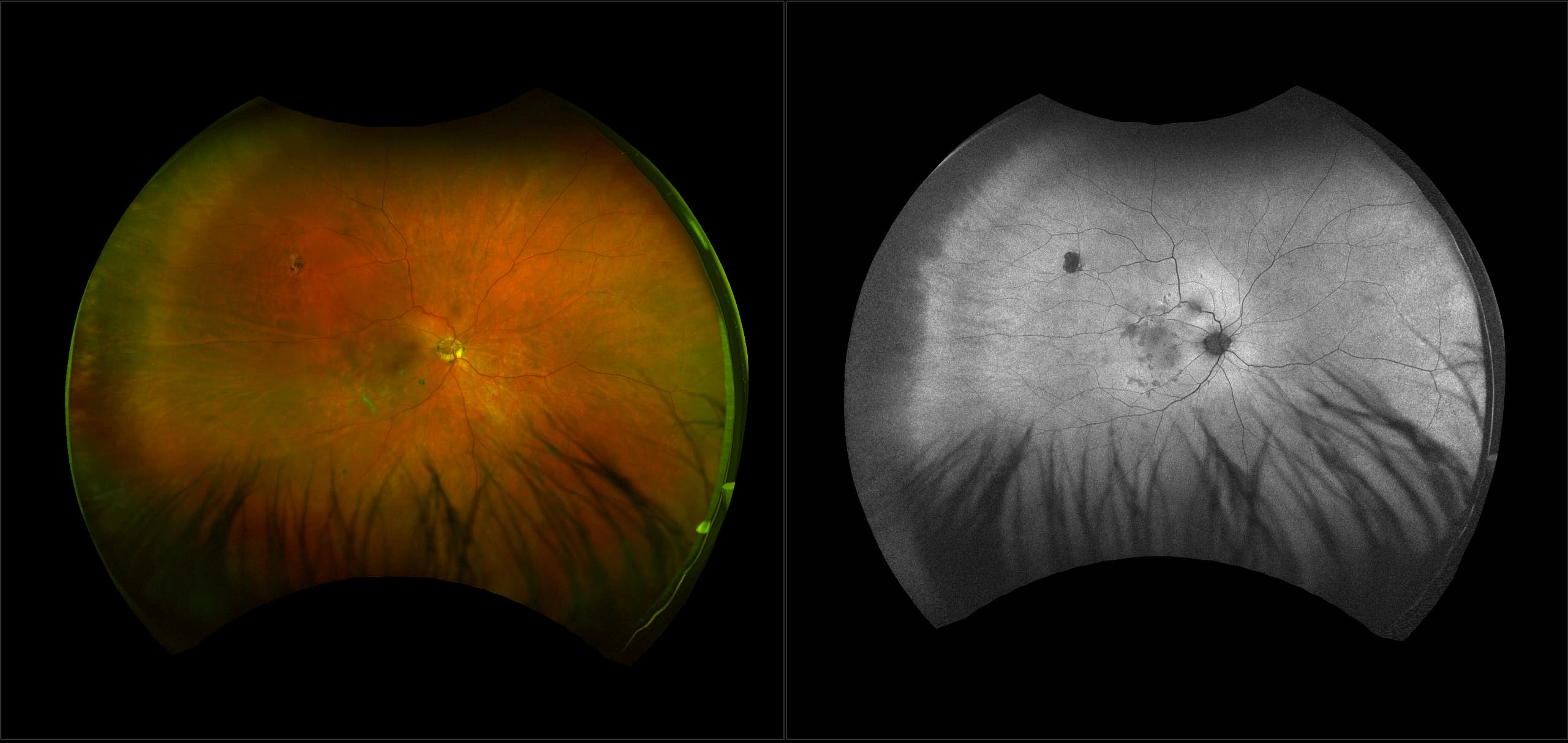 Acute posterior multifocal placoid pigment epitheliopathy (APMPPE)