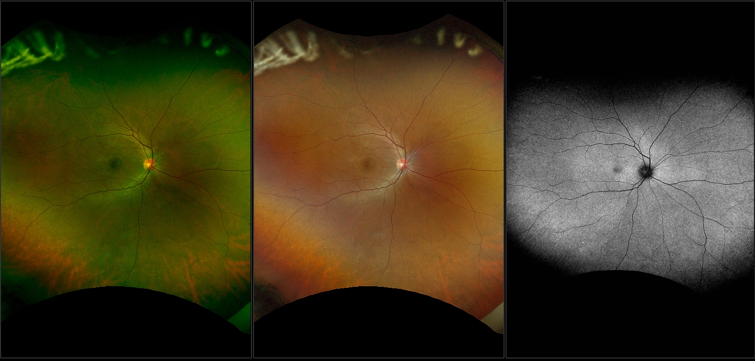 Branch Retinal Vein Occlusion with Macular Edema