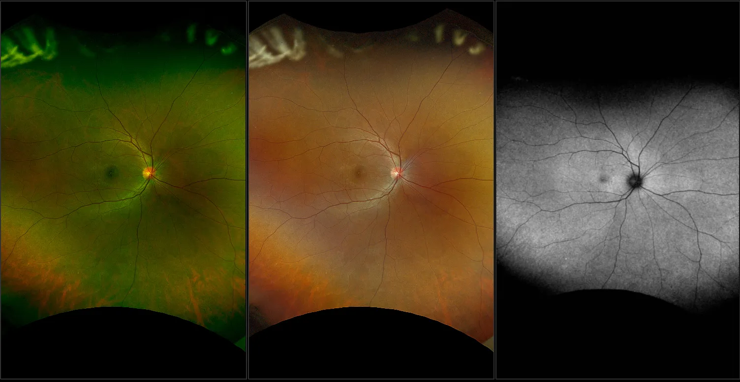 California - Vogt Koyanagi Harada Disease (VKH), RG, AF, RGB